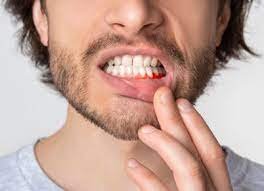 🦷 How to Cure Gum Disease Without a Dentist: Natural Remedies That Work